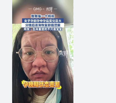<strong>女子分享孕期分娩后容貌变化</strong>