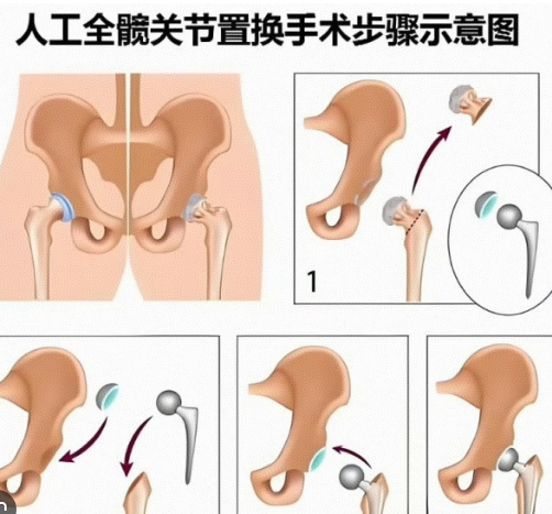 <strong>郎平置换了膝盖颈椎和髋关节</strong>