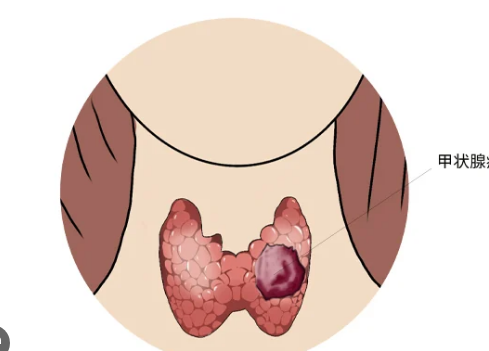 甲状腺癌为什么越来越常见